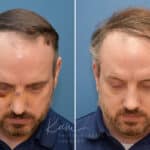 Rhinoplasty before and after photos in Voorhees, NJ, Patient 2291