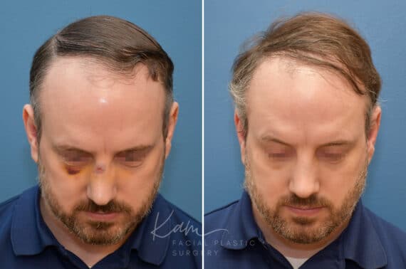 Rhinoplasty before and after photos in Voorhees, NJ, Patient 2291