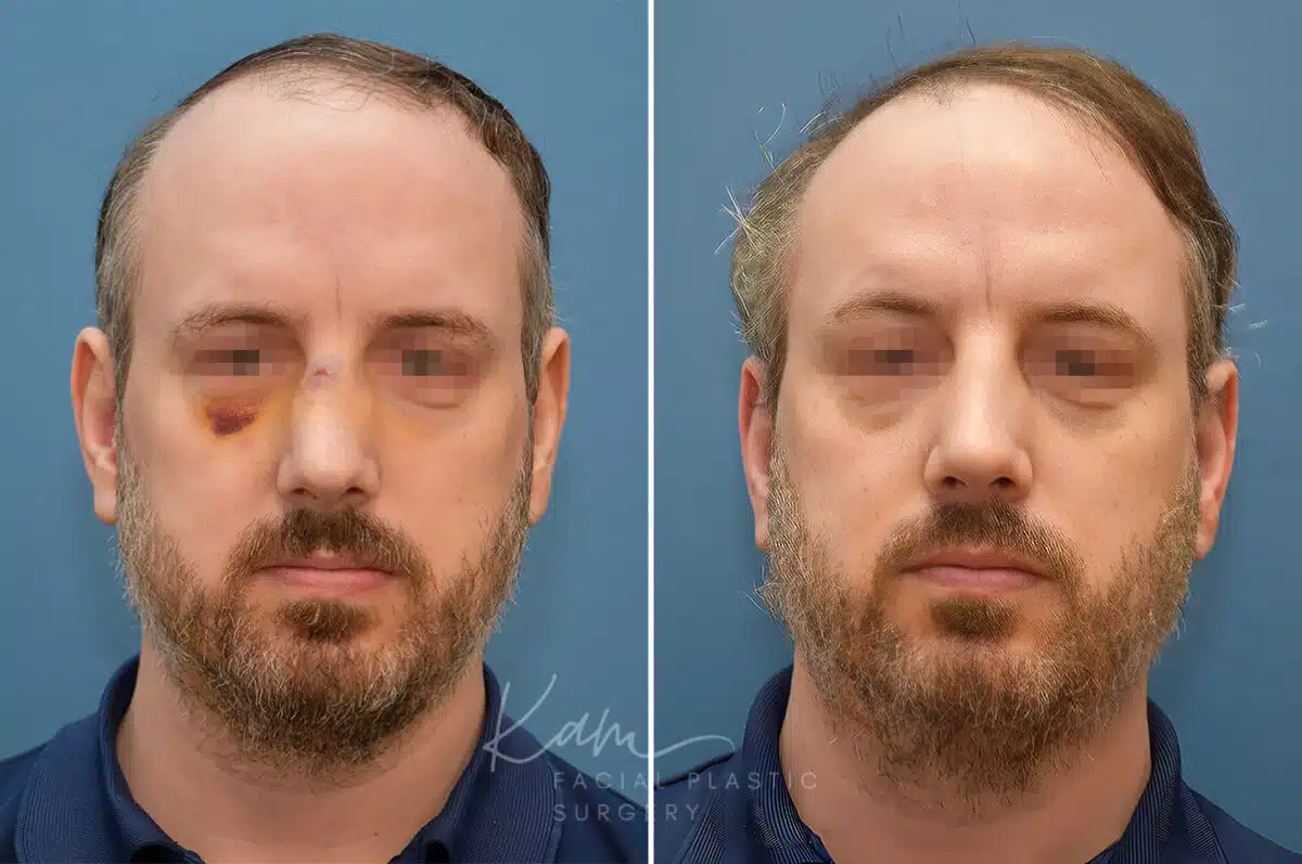 Rhinoplasty before and after photos in Voorhees, NJ, Patient 2291