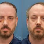 Rhinoplasty before and after photos in Voorhees, NJ, Patient 2291