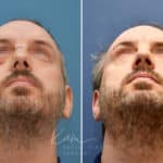 Rhinoplasty before and after photos in Voorhees, NJ, Patient 2291