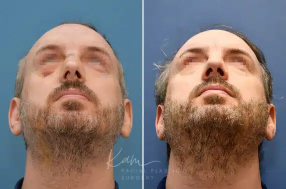 Rhinoplasty before and after photos in Voorhees, NJ, Patient 2291