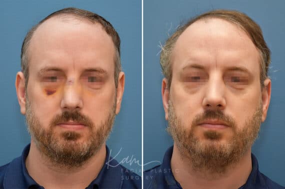 Rhinoplasty before and after photos in Voorhees, NJ, Patient 2291