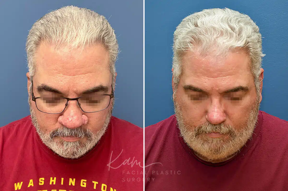 Rhinophyma before and after photos in Voorhees, NJ, Patient 2317