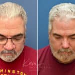 Rhinophyma before and after photos in Voorhees, NJ, Patient 2317