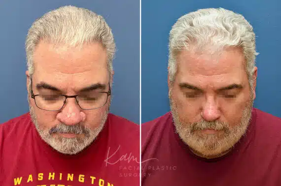 Rhinophyma before and after photos in Voorhees, NJ, Patient 2317