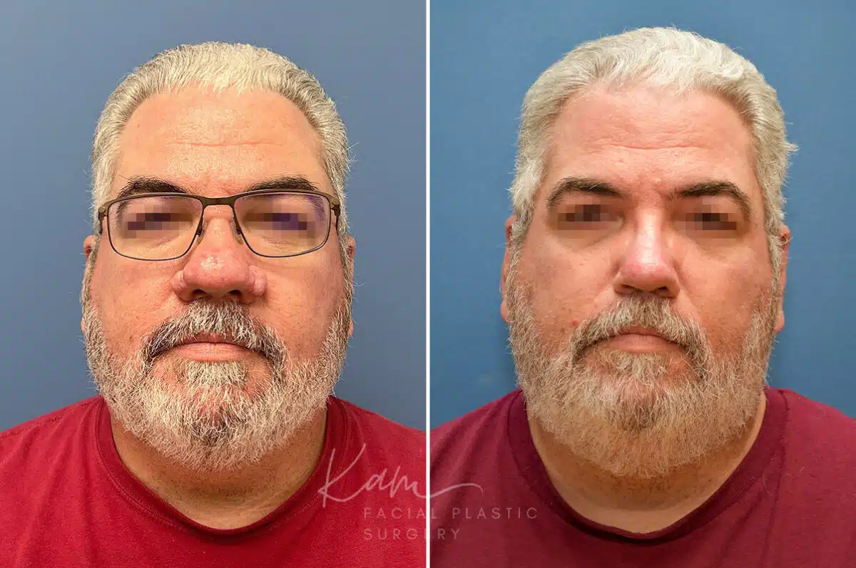 Rhinophyma before and after photos in Voorhees, NJ, Patient 2317