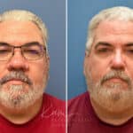 Rhinophyma before and after photos in Voorhees, NJ, Patient 2317