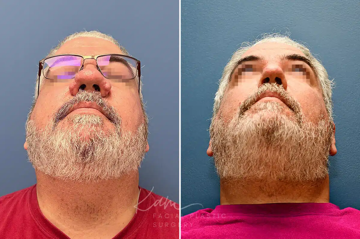 Rhinophyma before and after photos in Voorhees, NJ, Patient 2317