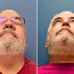Rhinophyma before and after photos in Voorhees, NJ, Patient 2317