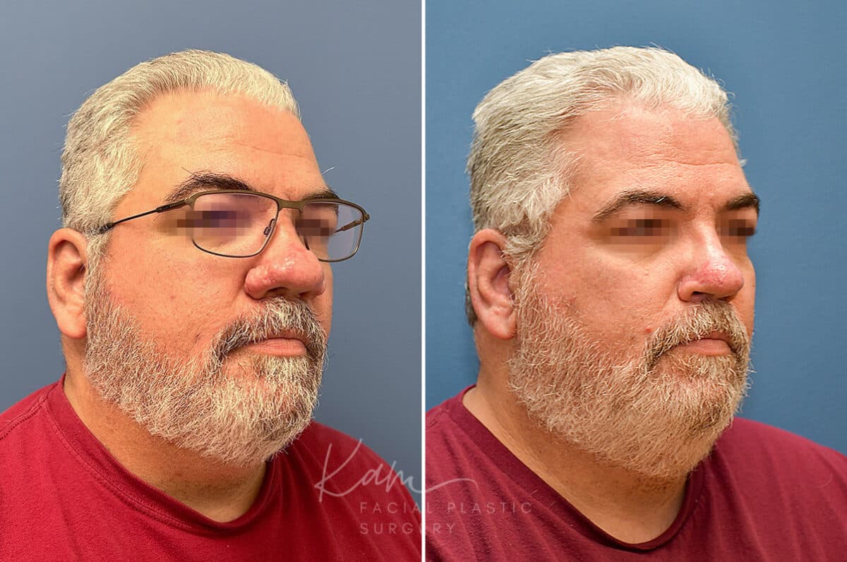 Rhinophyma before and after photos in Voorhees, NJ, Patient 2317