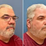 Rhinophyma before and after photos in Voorhees, NJ, Patient 2317
