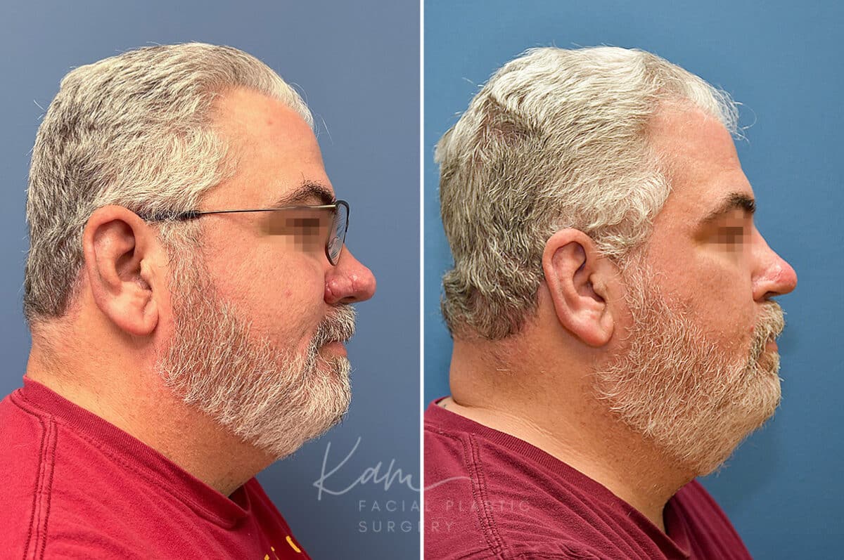 Rhinophyma before and after photos in Voorhees, NJ, Patient 2317