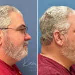 Rhinophyma before and after photos in Voorhees, NJ, Patient 2317