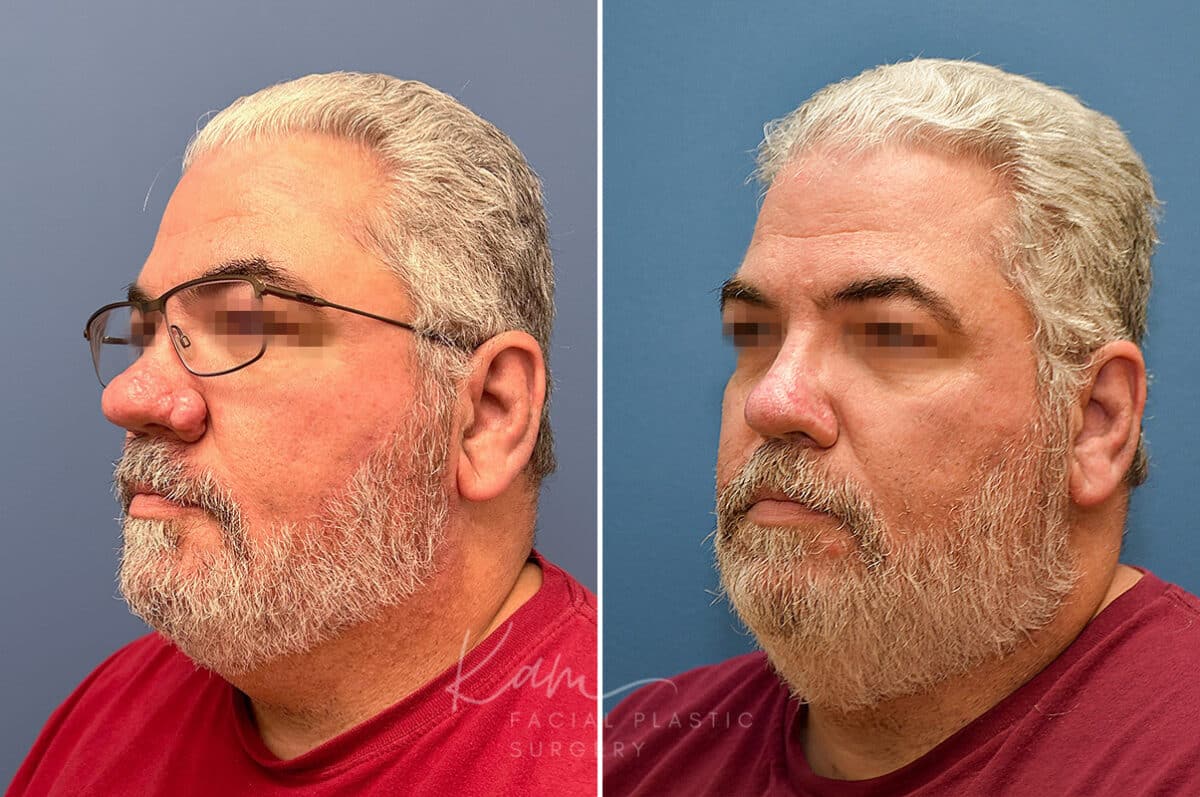 Rhinophyma before and after photos in Voorhees, NJ, Patient 2317