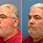 Rhinophyma before and after photos in Voorhees, NJ, Patient 2317