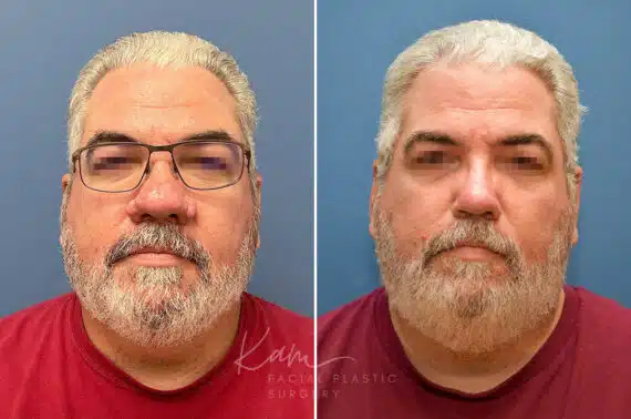 Rhinophyma before and after photos in Voorhees, NJ, Patient 2317