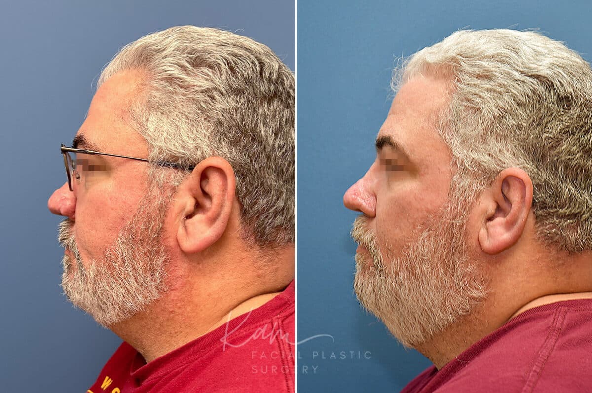 Rhinophyma before and after photos in Voorhees, NJ, Patient 2317