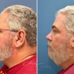 Rhinophyma before and after photos in Voorhees, NJ, Patient 2317