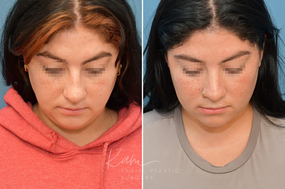 Rhinoplasty before and after photos in Voorhees, NJ, Patient 3653