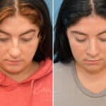 Rhinoplasty before and after photos in Voorhees, NJ, Patient 3653