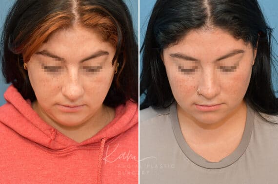 Rhinoplasty before and after photos in Voorhees, NJ, Patient 3653
