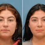 Rhinoplasty before and after photos in Voorhees, NJ, Patient 3653