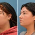 Rhinoplasty before and after photos in Voorhees, NJ, Patient 3653