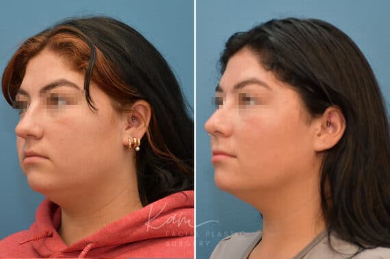 Rhinoplasty before and after photos in Voorhees, NJ, Patient 3653