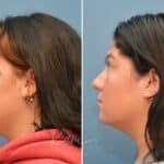 Rhinoplasty before and after photos in Voorhees, NJ, Patient 3653