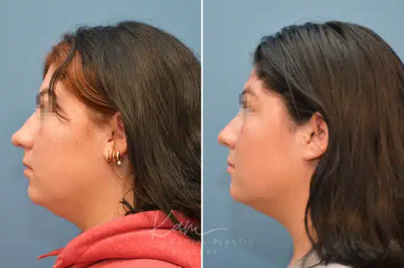 Rhinoplasty before and after photos in Voorhees, NJ, Patient 3653