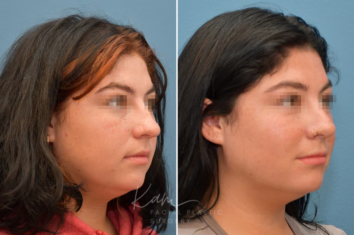 Rhinoplasty before and after photos in Voorhees, NJ, Patient 3653