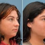 Rhinoplasty before and after photos in Voorhees, NJ, Patient 3653