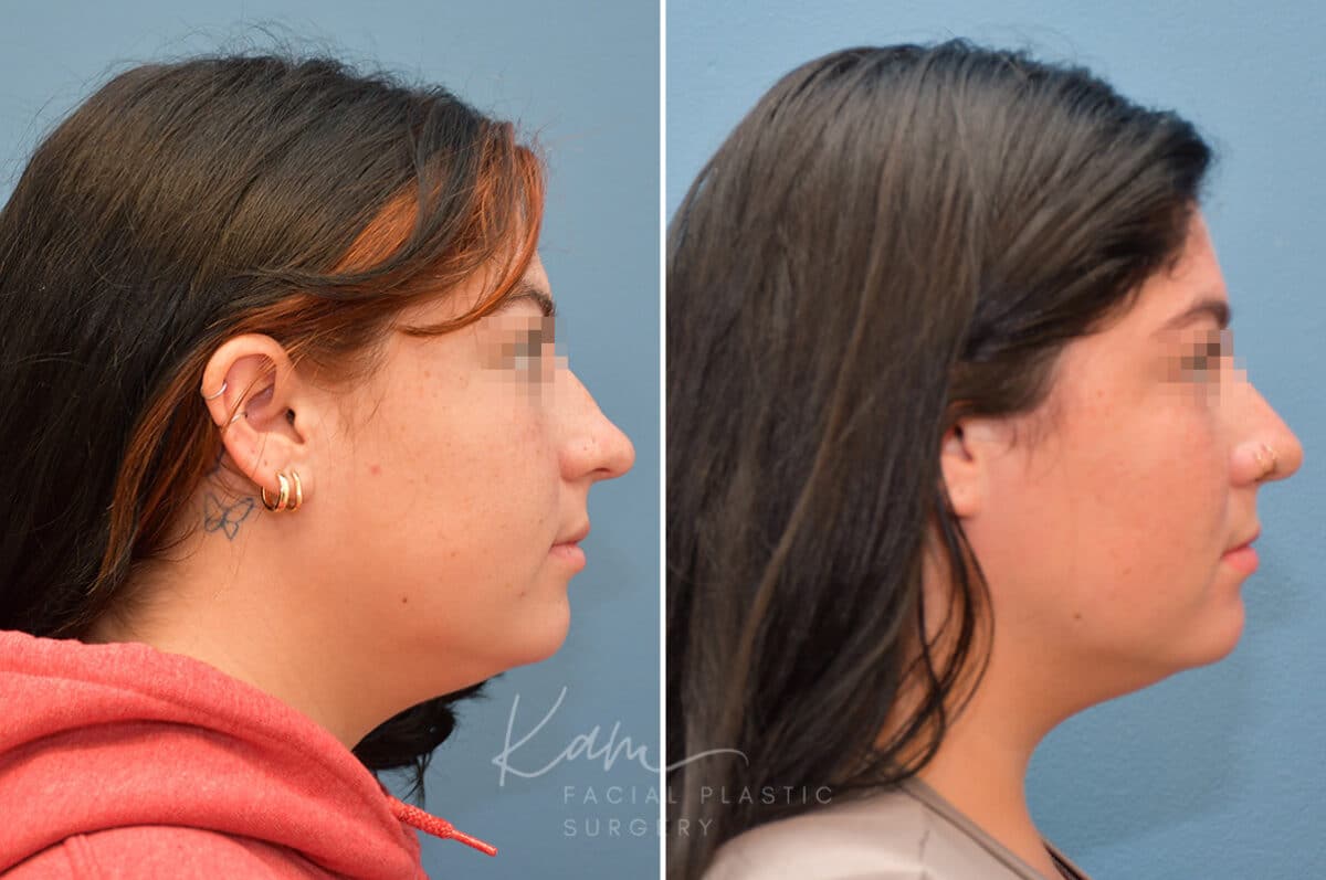 Rhinoplasty before and after photos in Voorhees, NJ, Patient 3653