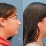 Rhinoplasty before and after photos in Voorhees, NJ, Patient 3653