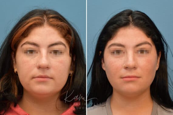 Rhinoplasty before and after photos in Voorhees, NJ, Patient 3653