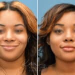 Rhinoplasty before and after photos in Voorhees, NJ, Patient 3695
