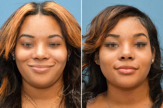 Rhinoplasty before and after photos in Voorhees, NJ, Patient 3695
