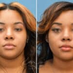 Rhinoplasty before and after photos in Voorhees, NJ, Patient 3695