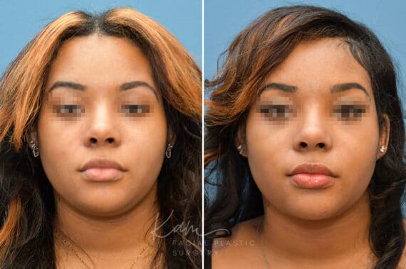 Rhinoplasty before and after photos in Voorhees, NJ, Patient 3695