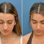 Rhinoplasty before and after photos in Voorhees, NJ, Patient 3699