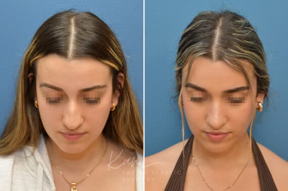 Rhinoplasty before and after photos in Voorhees, NJ, Patient 3699