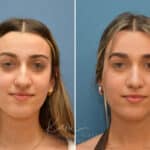 Rhinoplasty before and after photos in Voorhees, NJ, Patient 3699