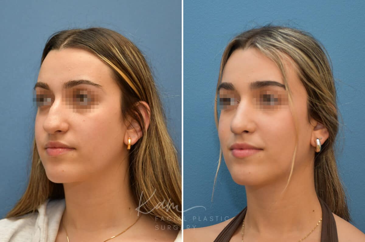 Rhinoplasty before and after photos in Voorhees, NJ, Patient 3699