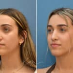 Rhinoplasty before and after photos in Voorhees, NJ, Patient 3699