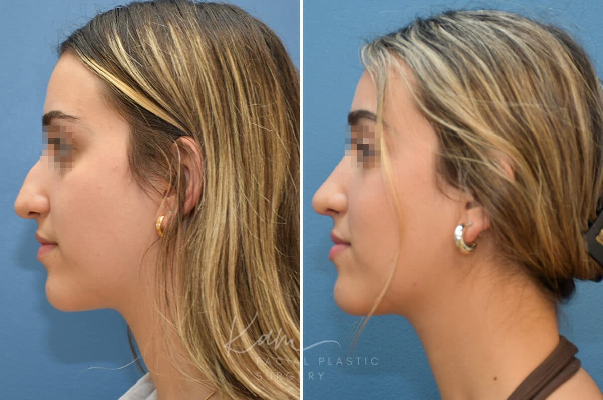 Rhinoplasty before and after photos in Voorhees, NJ, Patient 3699