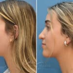 Rhinoplasty before and after photos in Voorhees, NJ, Patient 3699