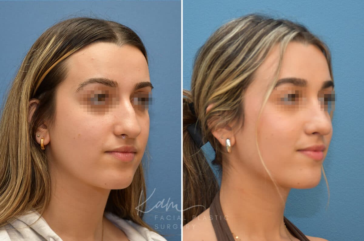 Rhinoplasty before and after photos in Voorhees, NJ, Patient 3699