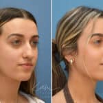 Rhinoplasty before and after photos in Voorhees, NJ, Patient 3699