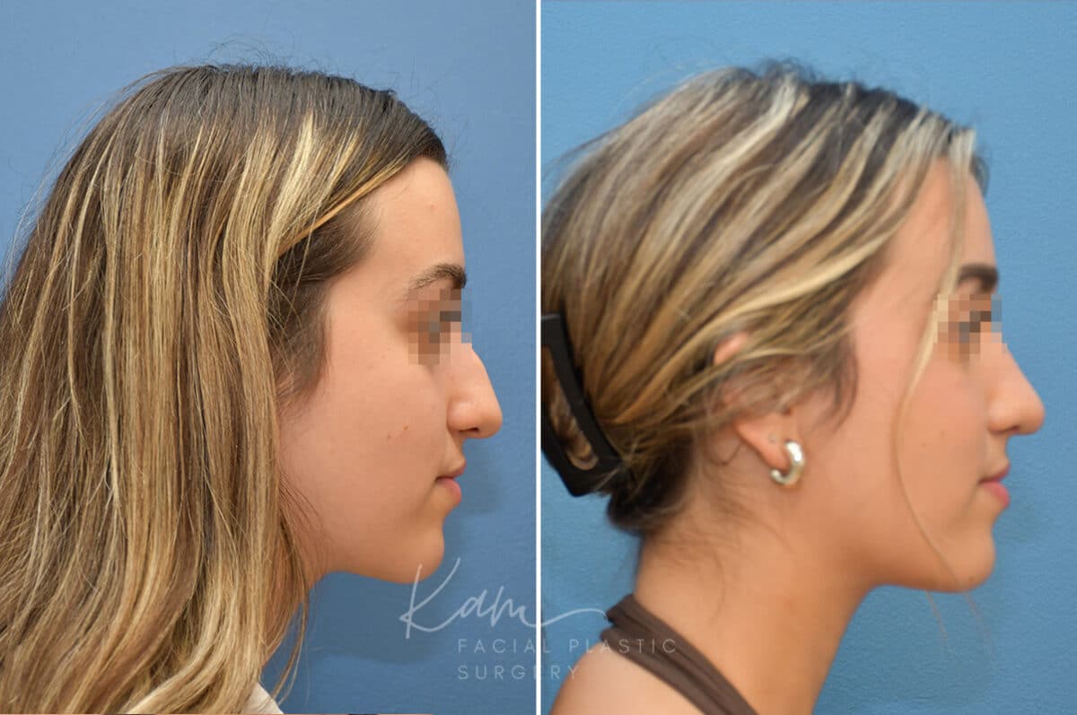 Rhinoplasty before and after photos in Voorhees, NJ, Patient 3699